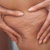 Celulite piora com alimentação inflamatória; veja como prevenir