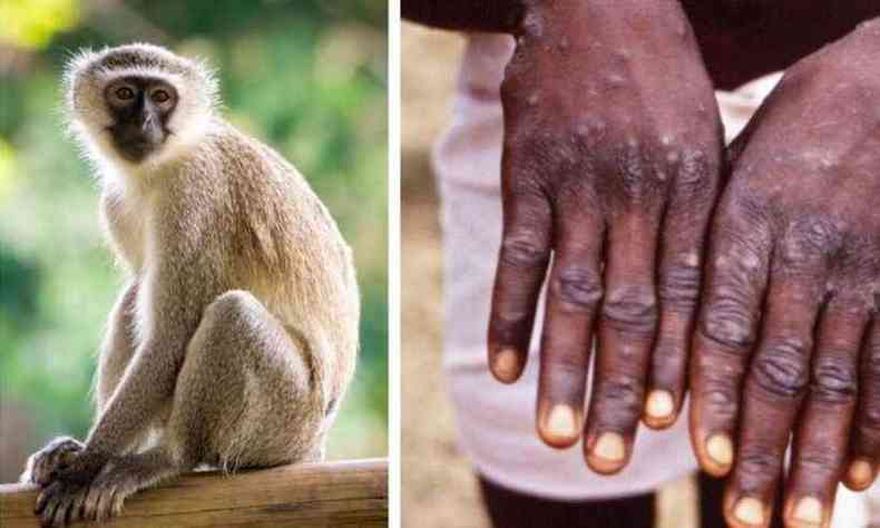 Montagem de foto: à esq., um macaco; à dir., duas mãos com bolhas de varíola