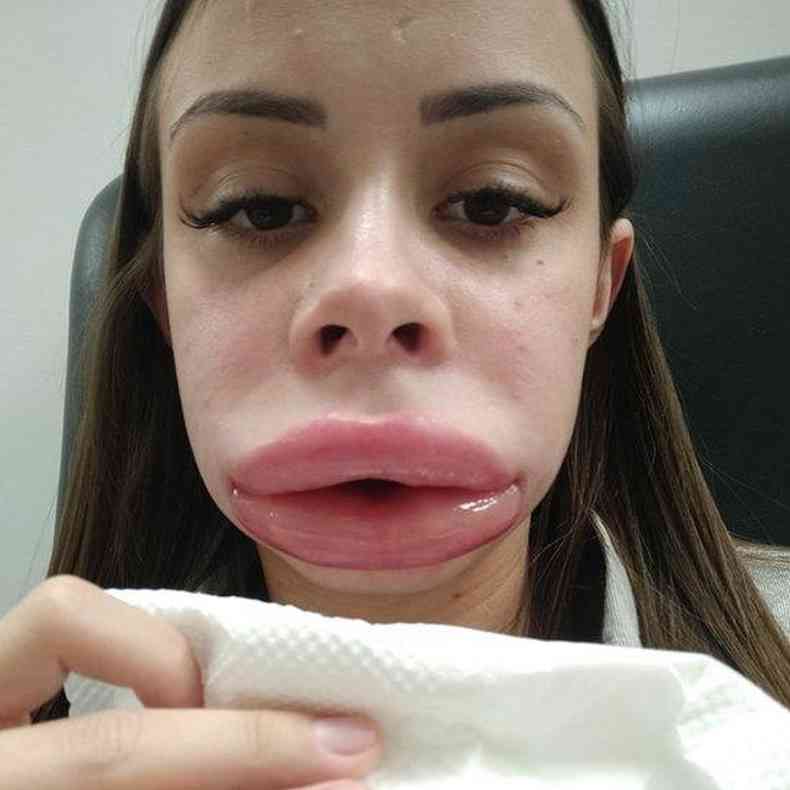 Pamela Andrade com inchao labial