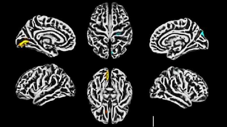 Ressonncia magntica mostra alteraes na estrutura do crtex cerebral; em amarelo, a reduo na espessura cortical; em azul, o aumento da espessura(foto: Unicamp)