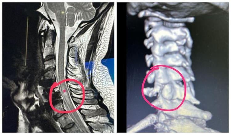 Radiografias mostram lesões na coluna