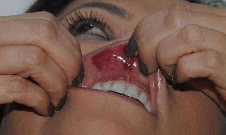Vtima mostra os ferimentos na boca aps levar um soco (foto: Arquivo Pessoal)