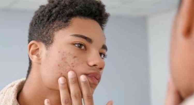 O engenheiro Leonardo Conti conta que, depois de enfrentar a acne, ainda teve de lidar com as cicatrizes, que deixaram marcas na pele e na autoestima