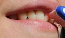 Saúde bucal: adiamento de consultas pode acarretar danos odontológicos