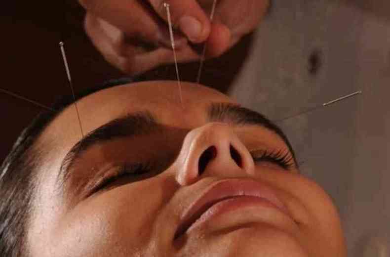 Mulher em sessão de acupuntura 