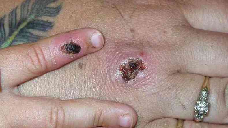 Lesões na pele por varíola dos macacos