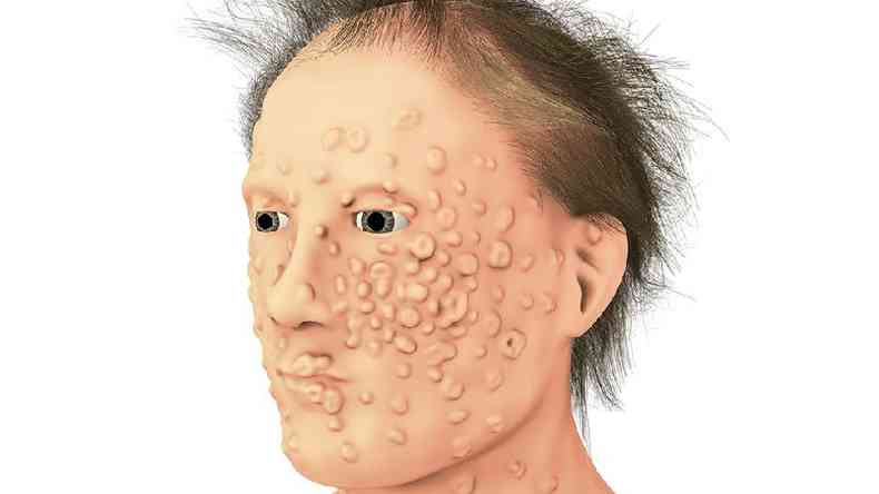 Muitos dos pacientes ficavam com cicatrizes terríveis no rosto e no corpo(foto: Getty Images)