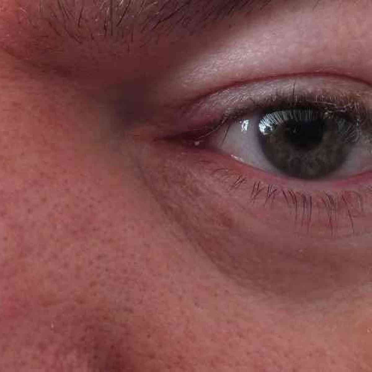 Olhos Inchados potenciais causas