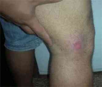 Jeans impediu que leso provocada pela bala de borracha fosse mais severa(foto: Hilton Milanez / Arquivo Pessoal)