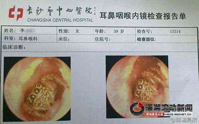 Ficha da paciente mostra imagem da aranha dentro do canal auditivo(foto: Reproduo internet / News.rednet.cn)