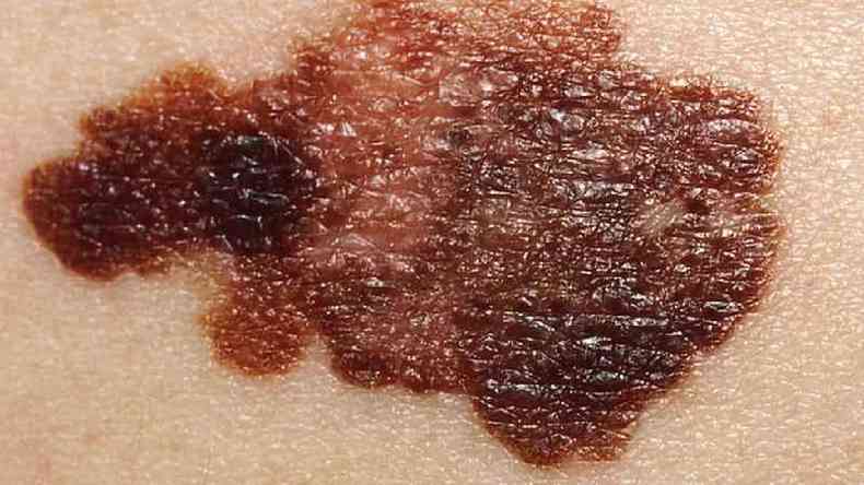 Pinta tpica de um melanoma