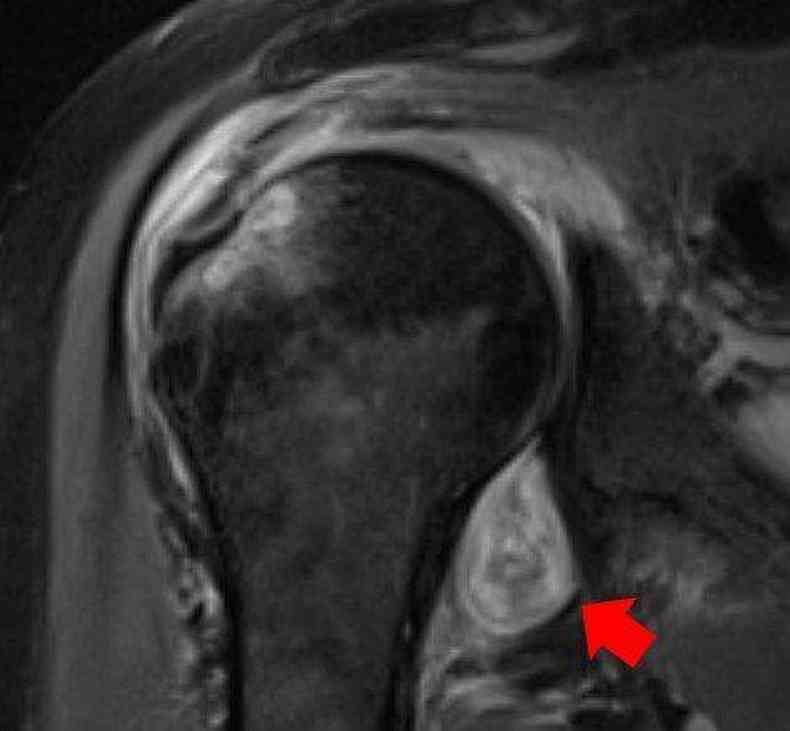 Imagem de ressonncia magntica do ombro de um paciente. A seta vermelha indica uma inflamao na articulao(foto: Northwestern University)
