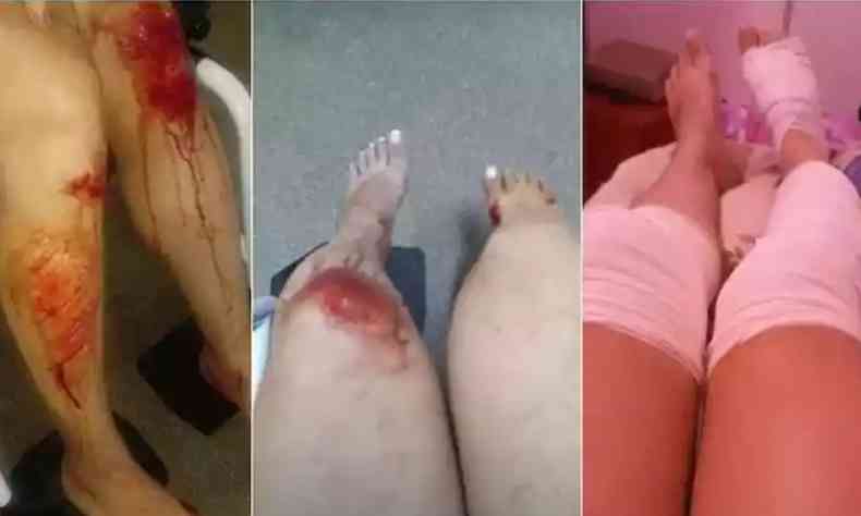 A vtima ficou com ps, pernas e joelhos machucados e foi levada ao hospital por uma pessoa que parou para ajudar(foto: Divulgao/PCDF)