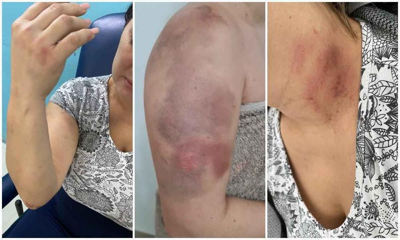 Paloma Agnes Silva de Oliveira, de 34 anos, teve hematomas nos braos e no pescoo, inchao na cabea e escoriaes no trax, no abdmen e nas pernas