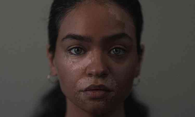moa morena com vitiligo no rosto