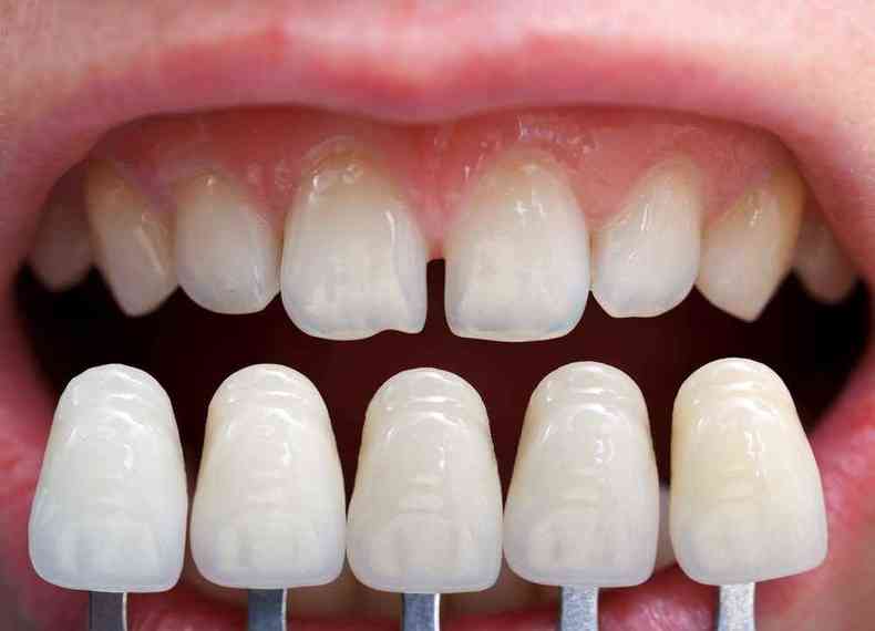 Lentes de Porcelana Dental  Foto: Pixabay