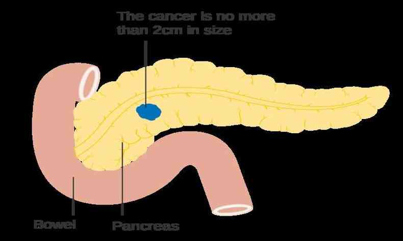 Diagnstico precoce do cncer no pncreas representa 4% das mortes no pas(foto: Reproduo da internet)