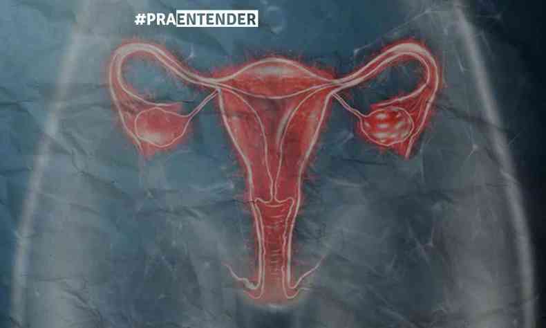 Representação de um útero feminino vermelho em fundo escuro demonstrando onde fica o órgão responsável pela endometriose dentro da cavidade abdominal 