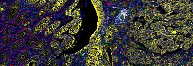 Imagem mostra transio de clulas normais (esquerda) para cancergenas do cncer colorretal (direita): evoluo da doena tem rastros genticos que podem ser alvo de exames de diagnstico