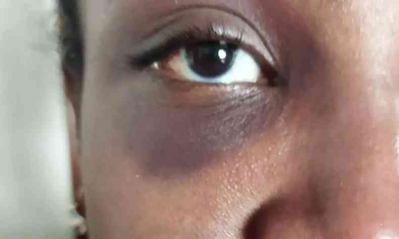 Foto mostra parte do rosto de uma mulher negra com hematoma no olho 