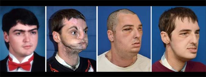 Fotos mostram o resultado das 23 operaes feitas em Richard Lee Norris, a primeira foto mostra como ele era antes do acidente(foto: AFP PHOTO / UNIVERSITY OF MARYLAND MEDICAL CENTER )