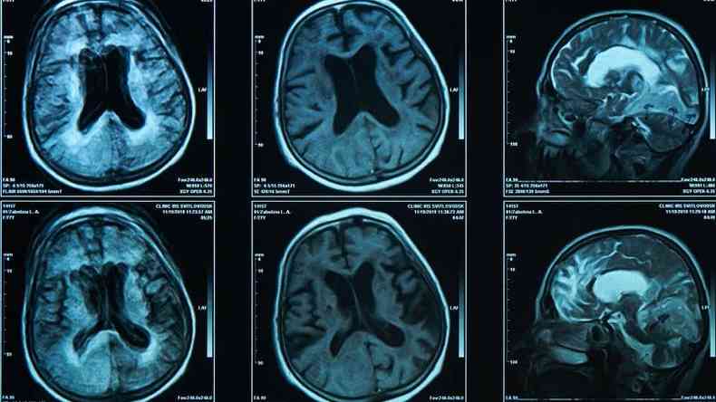 Crebros humanos visualizados em exames de imagem