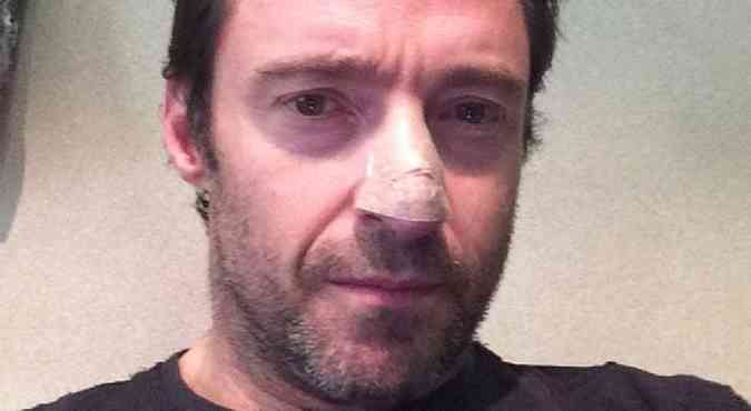 Hugh Jackman postou uma foto no Instagram mostrando o curativo no nariz(foto: Reproduo Internet / https://instagram.com/thehughjackman)