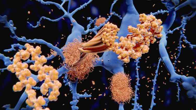 Acmulo de beta-amiloide entre os neurnios