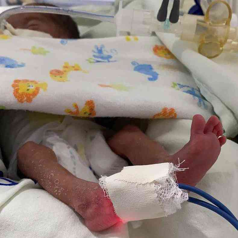 Quanto mais prematuro o beb, maiores os riscos de ter complicaes aps o nascimento(foto: iSEA)