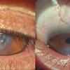 Coçar os olhos: jovem perde visão e precisará de transplante de córnea 