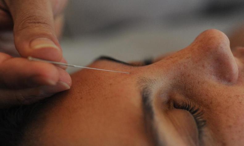 O medico acupunturista realiza procedimento na paciente