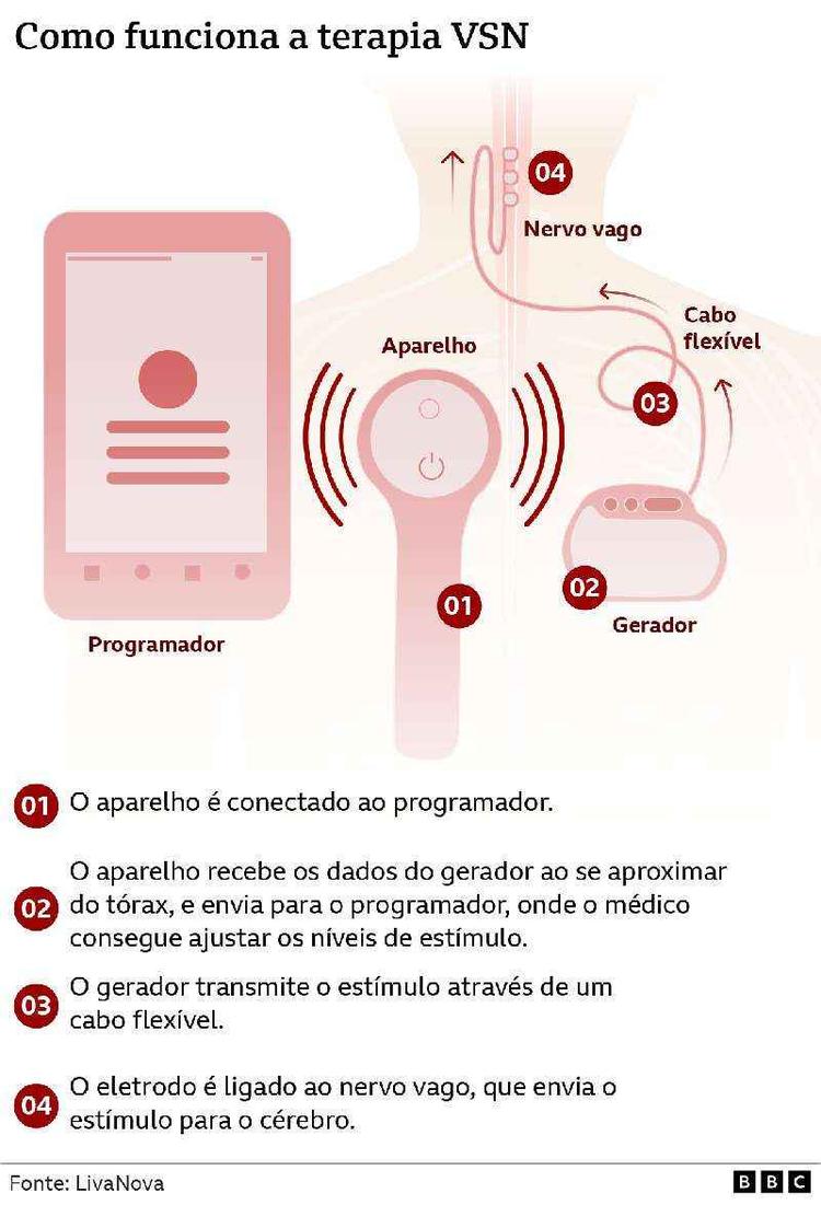 Ilustração mostra como funciona o implante no corpo