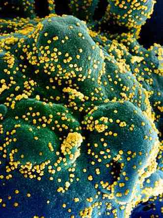 Clulas infectadas pelo novo coronavrus: busca por vacina provoca corrida internacional (foto: Handout/AFP)