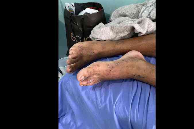 Detentos apresentaram sintomas como paralisia nas pernas e pele em decomposioOAB-RR/Divulgao
