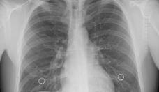 Tuberculose: Brasil  o 2 pas do mundo em mortes, diz a OMS