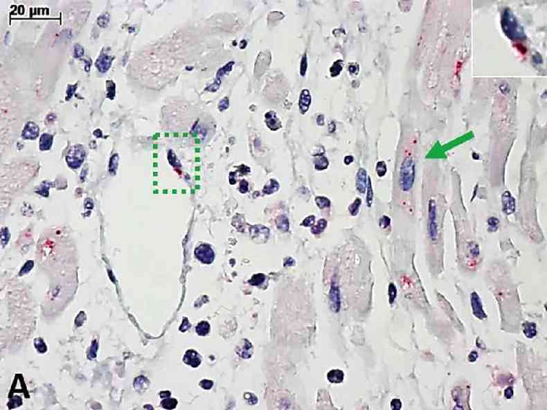 Corao de criana com miocardite pela covid-19, observado pelo microscpio comum. A colorao vermelha marca a infeco pelo vrus SARS-CoV-2. No quadrado pontilhado em verde (e no detalhe): clula de vaso sanguneo. Na seta verde: clula de msculo cardaco.