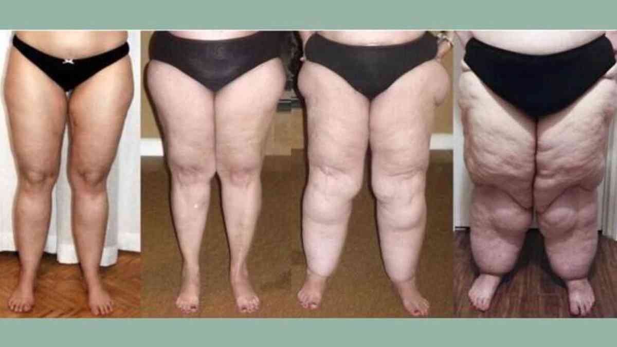 Como identificar e tratar lipedema, doença que causa acúmulo de gordura nas  pernas