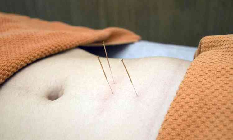 agulhas de acupuntura na barriga
