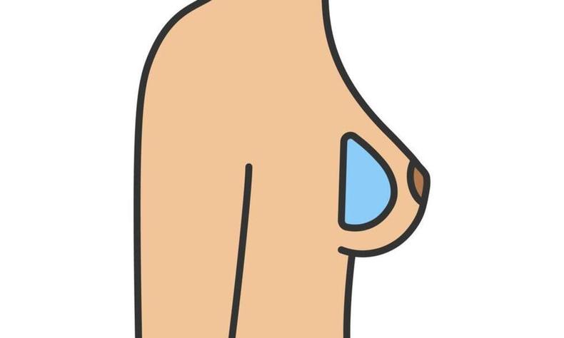 Ilustrao de seios de perfil, com prtese mamria