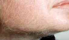  Hirsutismo: excesso de pelos no corpo acomete at 10% das mulheres 