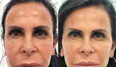 Gretchen e outras celebridades apostam na harmonizao facial