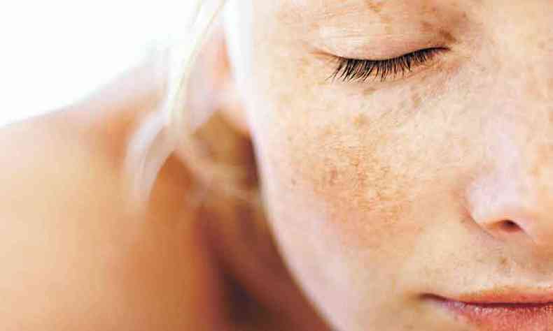 Estresse provocado pela COVID-19 pode provocar aparecimento de melasma, caracterizado por manchas escuras no rosto (foto: George Doyle/Lorena Vago/Reproduo da internet)