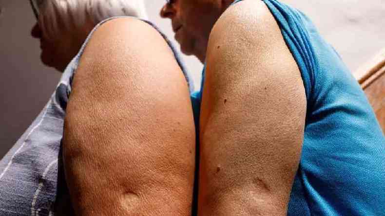 Marca de vacina contra a varola no brao de dois idosos