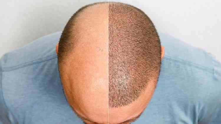 Topo da cabea de um homem careca antes e depois de fazer transplante