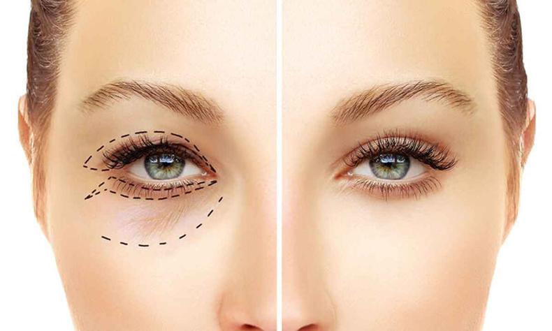 Blefaroplastia elimina bolsas de gordura e excesso de pele(foto: SBCPO/reprodução) Foto mostra Olhos femininos antes e depois de cirurgia plástica nas pálpebras
