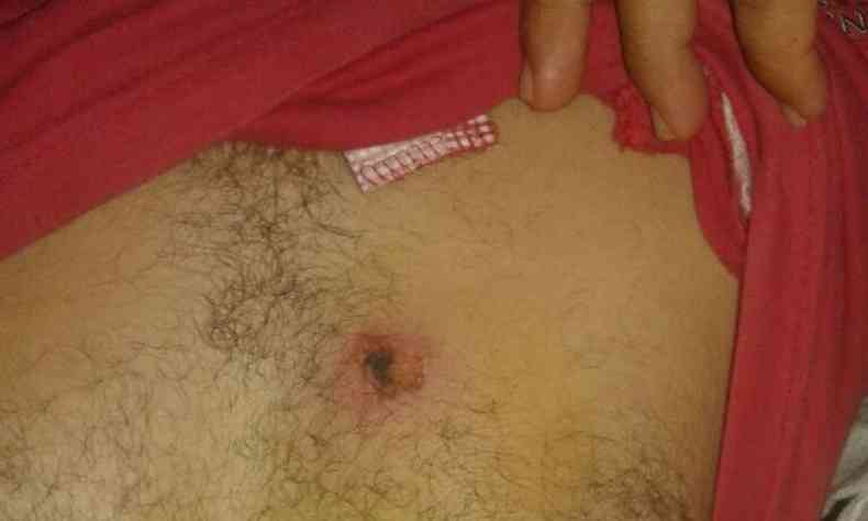 Apesar do projtil no ter perfurado o peito do vereador, o tiro causou um pequeno ferimento no peito do parlamenta(foto: Internet/ Whatsapp/ Divulgao )