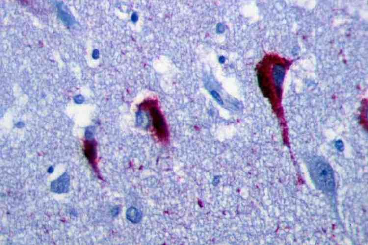 Emaranhado de fibras no crebro com Alzheimer: caminho de interveno