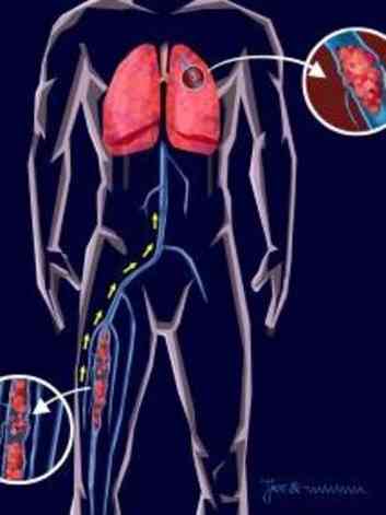 ilustrao do esqueleto humano mostrando o efeito da trombose venosa profunda (TVP)