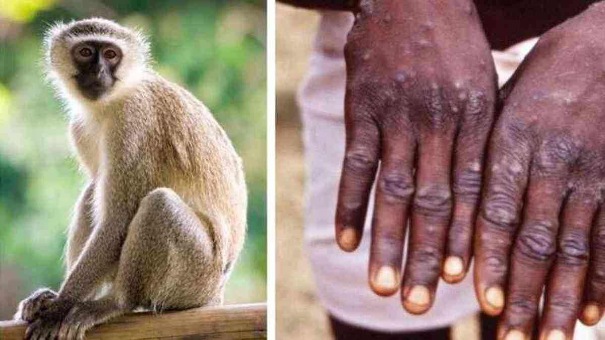 Varíola do Macaco: Sintomas, como é transmitida, cura e mais