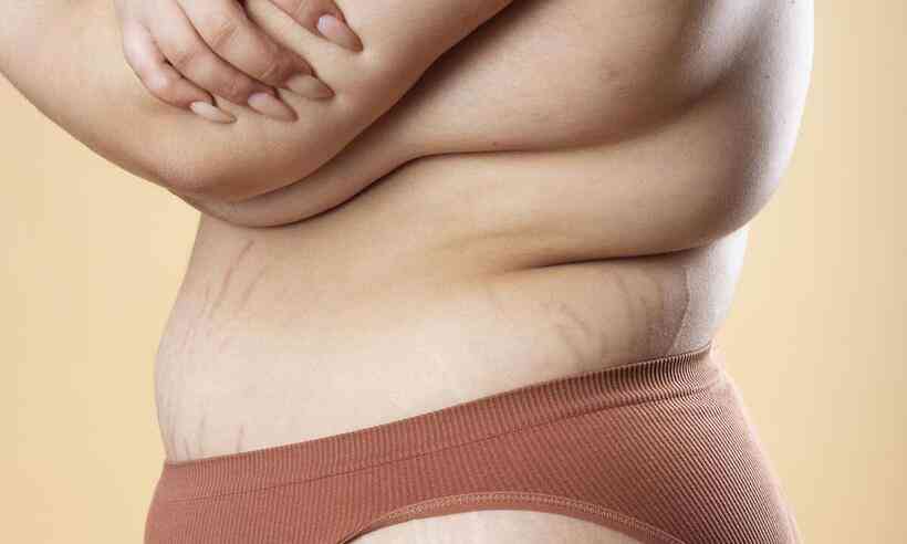 Doença causa peso nas pernas e é confundida com obesidade - Dani-se